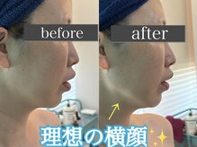 ビパール(bea pull)/輪郭、フェイスライン。二重あご