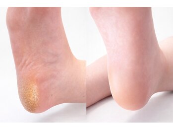 仕上がりにこだわる足裏角質ケア