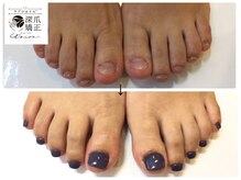 トイロ(toiro)/再発を防ぐ深爪矯正