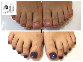 トイロ(toiro)/再発を防ぐ深爪矯正