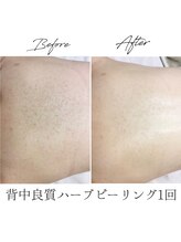 ビズビズ 梅田店(bisebise)/〈症例〉背中ニキビケア・赤み跡