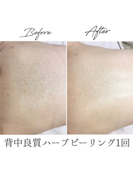 ビズビズ 梅田店(bisebise)/〈症例〉背中ニキビケア・赤み跡