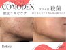 【赤ニキビケア専用】アクネ菌根本から改善(クリスティーナ)