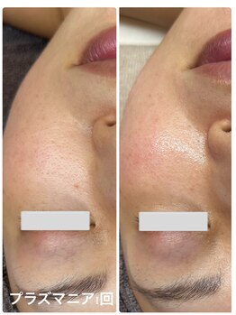 リッシュボーテ(RICHE BEAUTE)/プラズマピーリング/ビフォアフ