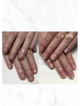 ティアラネイル 宇都宮/深爪矯正