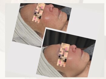 ビジュー(BIJOU)/韓国肌管理★ララピール★