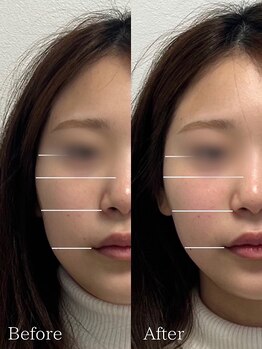 ひじ鍼灸整骨院/小顔鍼Before /After◎