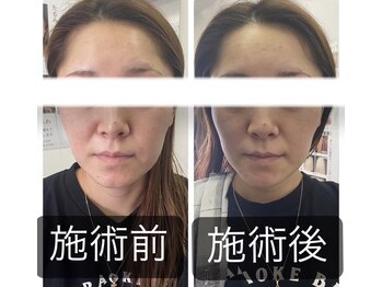 リベル(Liber)/高濃度ヒト幹細胞導入