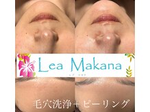 レアマカナ(LeaMakana)/毛穴洗浄＋ピーリング