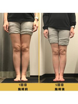 ベル/【40代会員様】O脚矯正の変化
