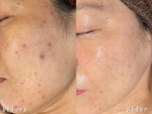 エヌエースキン 武蔵小杉店(Naskin)/ニキビケア、シワケア！