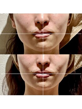 カルナ(CARNA)/お顔の左右差もしっかり整う