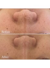 ミエル 神戸店(Miel)/毛穴洗浄はミエルにお任せ！