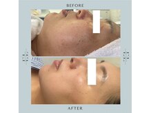 ジルフィー(GILFY)/医師監修の肌質改善フェイシャル