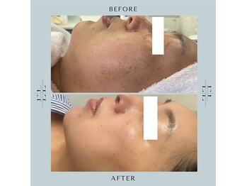 ジルフィー(GILFY)/医師監修の肌質改善フェイシャル