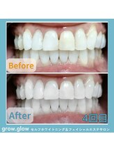 グロウ グロウ(grow.glow)/医療提携ホワイトニング