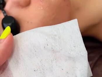 ボス 大曽根店(BOSS)/脱毛施術直後の脱毛効果です!