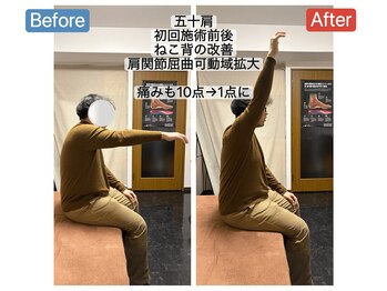 アンティオール 札幌店/50代男性　肩の痛み