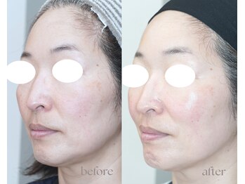 岩川治療院/ビタミンA集中導入 短期肌改善