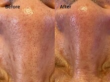 アンベリール みなとみらい店(Embellir)/毛穴洗浄beforeafter