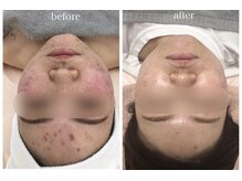 ベルフィーヌボーテ(BELFINE beaute)/クリスティーナニキビケア
