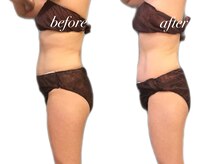 リリィブラン(Lily branc)/痩身上半身モニター様/お腹+腰