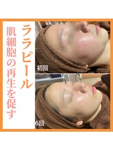 トータルビューティーサロン ヴィヴィエ(ViVier)/ララピール症例6回