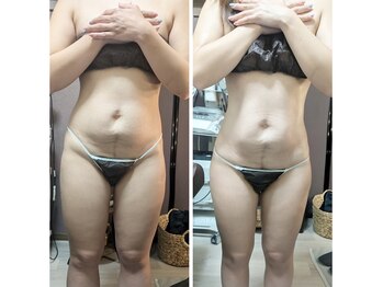 ラグーン(Lagoon)/WINBACK痩身