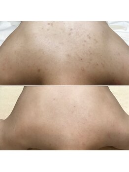 ヴィヴィ(ViVi)/HAAB REPRO 背中ハーフ