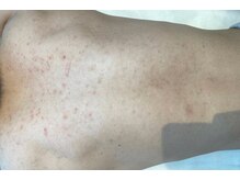 リベル 名古屋(Lebelle:)/ハーブピーリング専門名古屋