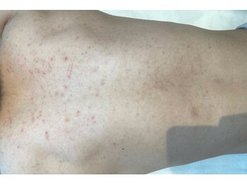 リベル 名古屋(Lebelle:)/ハーブピーリング専門名古屋