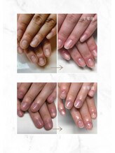 ティアラネイル 宇都宮/深爪矯正