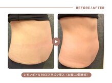 イエス マイサロン(yes My Salon)/レモンボトル施術例