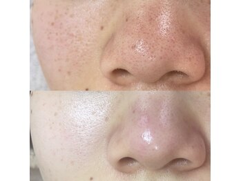 美身庵(Bishinan)の写真/毛穴の黒ずみや開きは年齢のせいと思われがち。が実は体の巡りや呼吸、生活習慣も大きく関係しています。