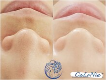 カロニア(CaLoNia)/毛穴・乾燥肌が気になる方