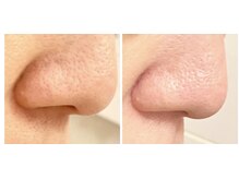 トータルビューティー 宝塚(Total Beauty)の雰囲気（ザラザラ毛穴、ブツブツ毛穴、ガサガサ肌を白玉肌に）