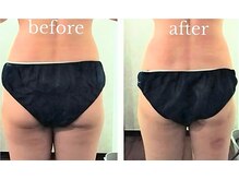 バービーホリック(barbie holic)/１３０分コース　１回の施術前後