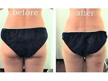 バービーホリック(barbie holic)/１３０分コース　１回の施術前後