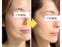 フェイスプラスリフ(FACE+RiF)/【幹細胞エクソソーム】