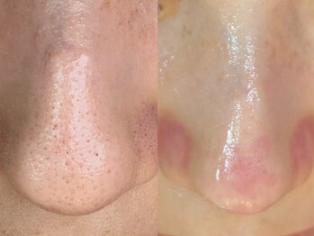 ダリア(Dahlia)/毛穴エクストラクション