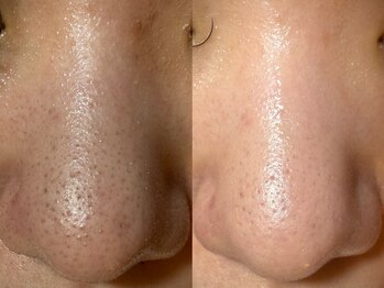 サイセイ(SAISEI)/札幌毛穴ケアはサイセイ!!