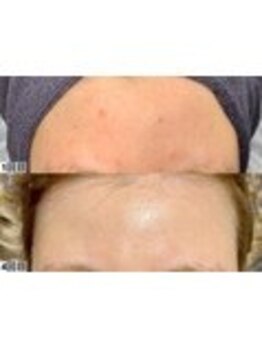 アンドミー 鹿児島中山(&me)/ハーブピーリング【ニキビケア】