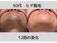 ビモア(Bmore)/★ビフォーアフター★