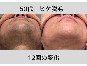 ビモア(Bmore)/★ビフォーアフター★