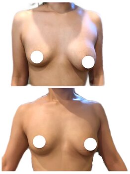 美人バスト 浦和店/【バストアップ★育乳】症例