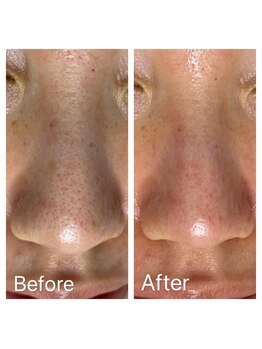 エステ シンセリティー(aesthetic sincerity)/毛穴洗浄