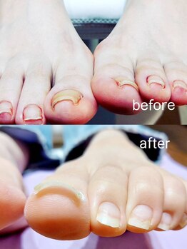 ソラ(sora)の写真/【巻き爪改善1本¥4980】痛みはなくても常に進行している巻き爪…靴の中の雑菌繁殖や臭いの原因にも!
