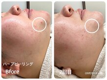 ラウレア 西条店(LAULEA)/ハーブピーリング