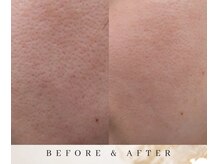 ゼロ アンド リセット(0ZERO&RESET)/【メンズ脱毛】0ZERO&RESET