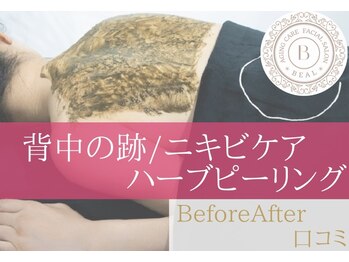 ベアール(beal)/背中の跡/背中ニキビケア